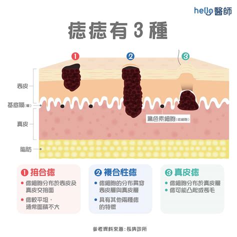 大痣|痣變大、痣多或長毛會變皮膚癌？認識痣的形成與原因